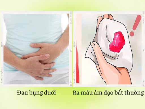 Triệu chứng sau mổ u nang buồng trứng